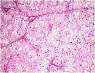 Chromophobe RCC
